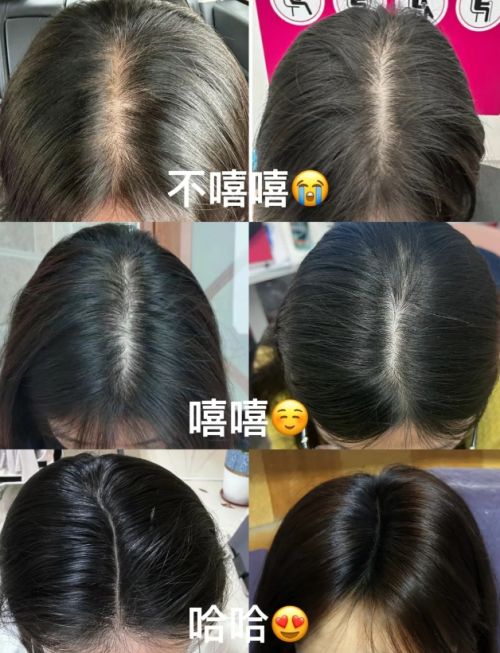 百天测评 防脱发生发增发密发哪个牌子好 十大性价比产品推荐