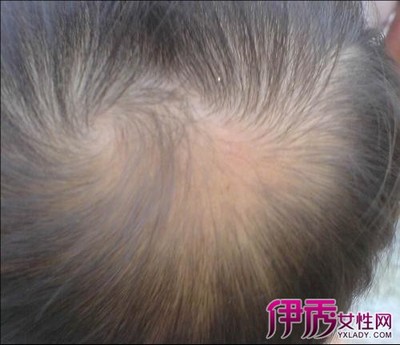 【图】掉头发用什么药可以治好呢 为你详解治疗脱发的好方法