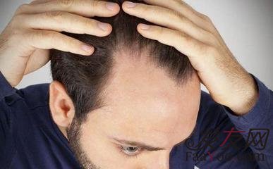 人到中年脱发厉害怎么办?