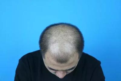 脱发产品我也都尝试过?90后脱发也不用怕,无痕植发重拾自信!