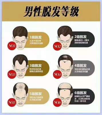 脱发能治疗成功吗?