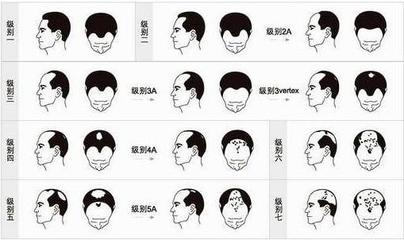 青少年脱发治疗方法