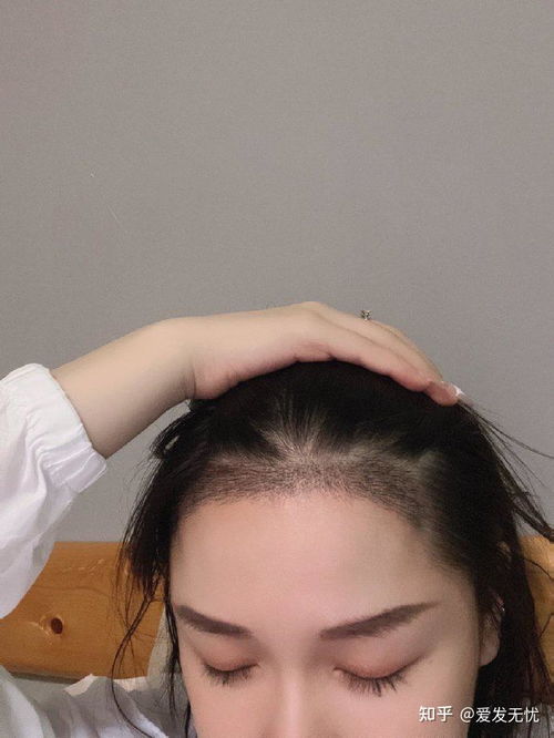 厦门 新生植发医院的治疗脱发效果怎么样