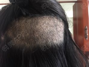 第八天拍的照片 基本上额头已经不红了,就是洗这些地...治疗脱发 悦美整形
