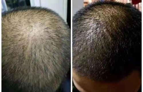 脱发怎么办怎么治疗