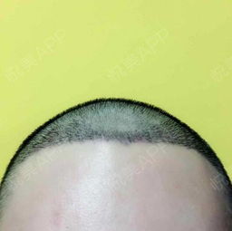 植发后第7天 其实对生活工作没有影响,依然正常的在...治疗脱发 悦美整形