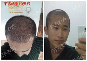 遗传性脱发能治愈吗 植发的感悟就是节约时间少走弯路