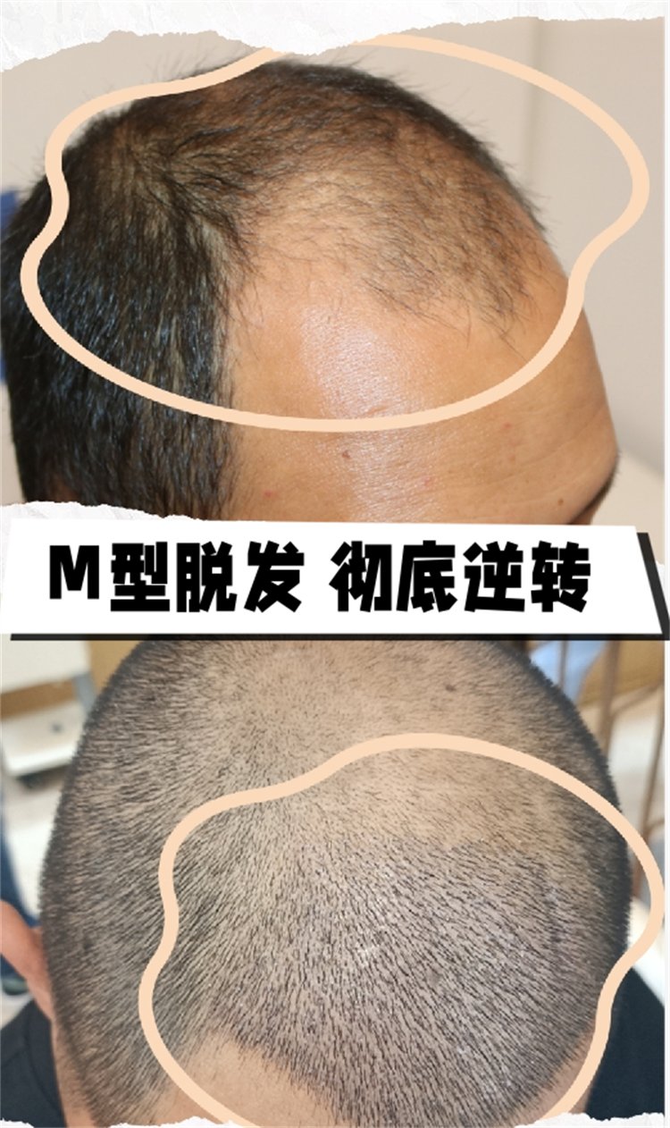 治疗m型脱发,用米诺加非那.第二个月