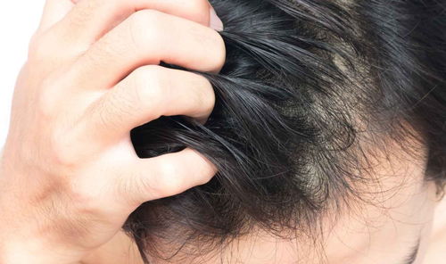 脂溢性脱发到底是怎么回事 医院一般不告诉你