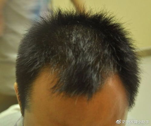 梅花针治疗脂溢性脱发是否会有理想效果