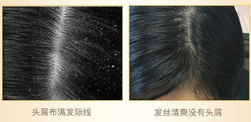 拯救脱发 巨星纷纷代言,大品牌防脱产品,留住每一根头发