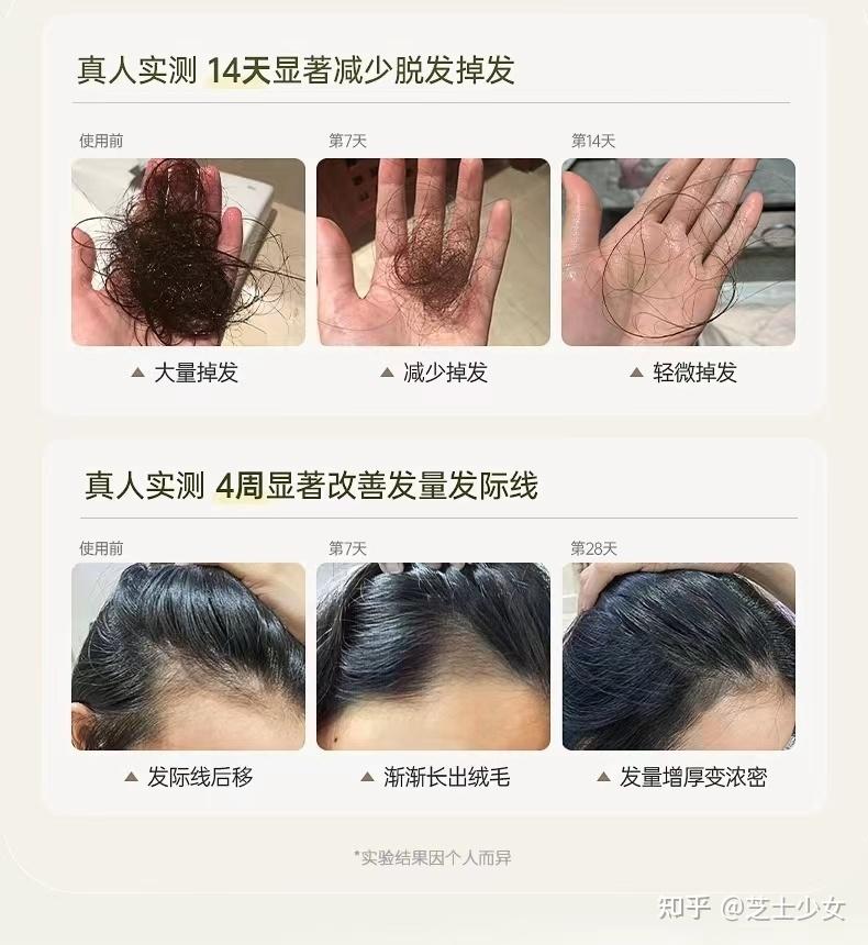 治疗脂溢性脱发的方法?