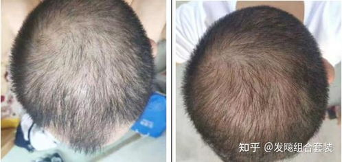 脱发厉害怎么搞