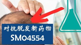 美国脱发博主讲治疗脱发的四种主流方案 雄性脱发 脂溢性脱发 非那雄胺,米诺地尔,ru58841,度他雄胺,干细胞