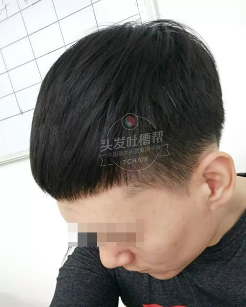 发友 m型脱发不用怕 小单位加密就能轻松治愈它