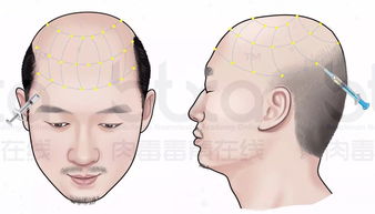 肉毒毒素注射预防和治疗脱发