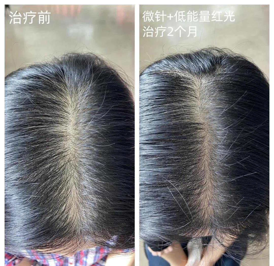 第一次体验三甲医院治疗脱发