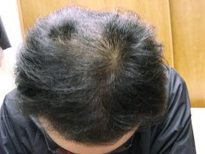 男仕脱发的正确治疗方法