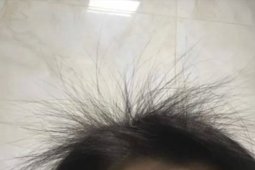 3 个月脱发逆袭 发量暴增方法简单成本低我看谁还不知道