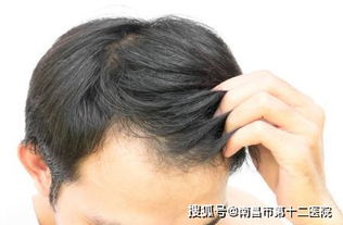 毛囊检测真的有必要吗 治疗脱发不做毛囊检测,基本属于白费劲