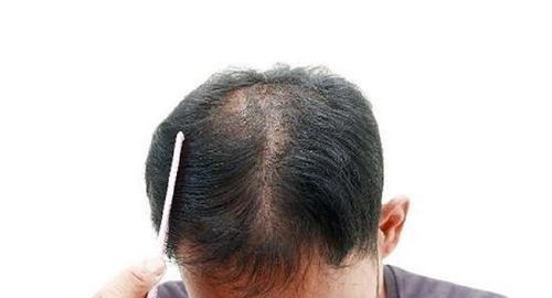 掉发到什么程度需要重视 不同脱发情况如何治疗