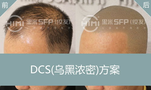 纹发与脱发治疗技术及方法 全面解析