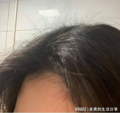 哪个品牌的防脱发生发产品效果更佳 这几款在用户口碑中脱颖而出