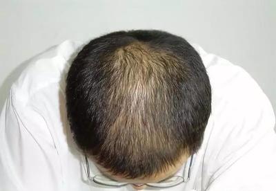 脱发严重?那就用这6种中药方,让你逐渐摆脱脱发!