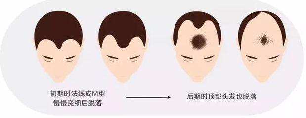 全民脱发时代!第一批90后开始“秃顶”了!不想脱发的人都在看