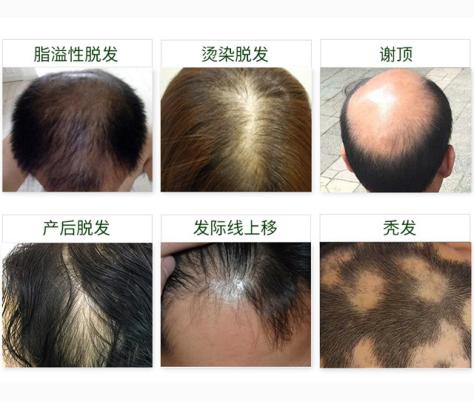 LAVER毛囊生物科技与脱发的治疗