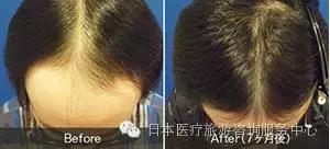 jmt日本看病 日本脱发植发治疗,harg疗法介绍