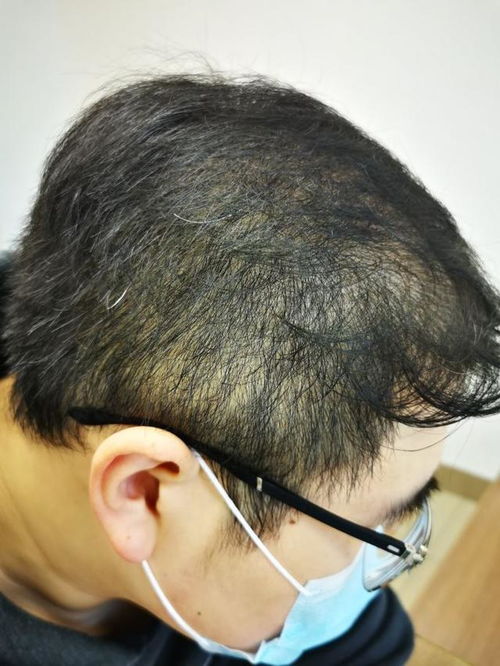 头顶弥漫脱发,只是雄激素性秃发么