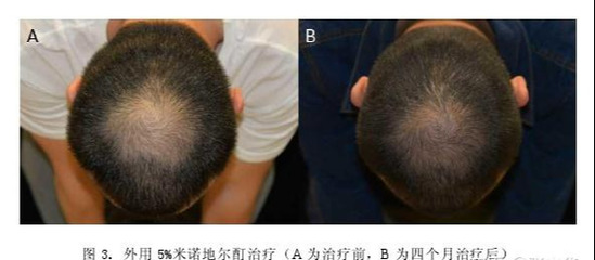 脱发能恢复吗?揭秘5大常见脱发的临床治疗方法(附临床案例)
