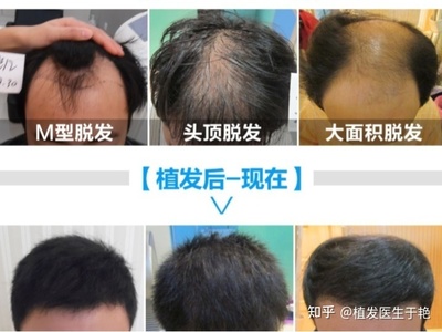 雄性激素脱发,脂溢性脱发现在医学上的治疗方法是怎样的?