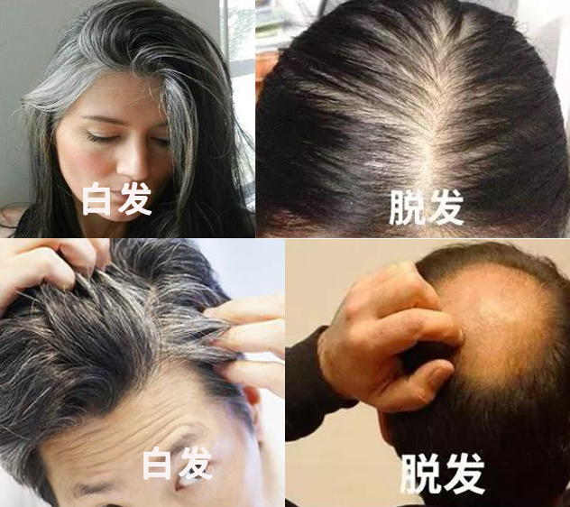 脱发秃顶渐失女人缘,耍帅不再难自信,29岁小伙儿长出头发.