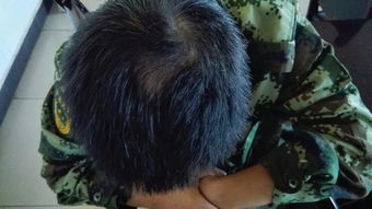 脱发治疗指南 从成因到有效应对