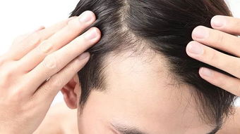 生姜擦头皮真能治脱发吗？专家解析脱发类型与科学疗法