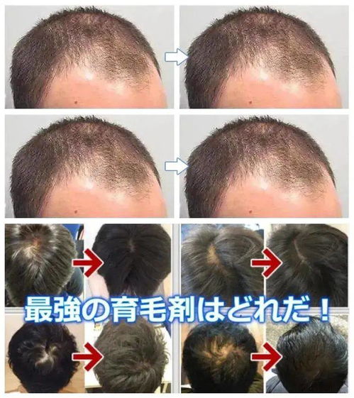 熬夜脱发、发际线后移，真的没救了吗？